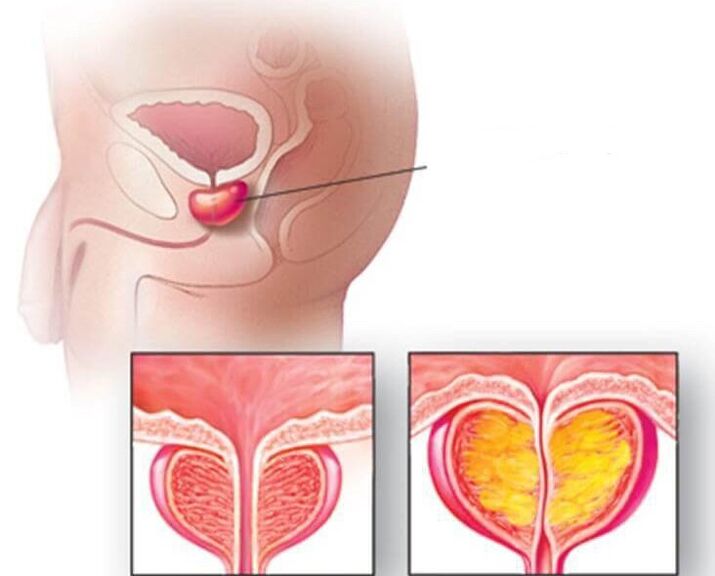 Umiestnenie prostaty, normálna prostata a zväčšená pri chronickej prostatitíde