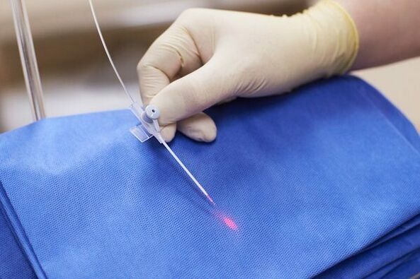 V niektorých prípadoch sa pri chronickej prostatitíde používa laserová terapia