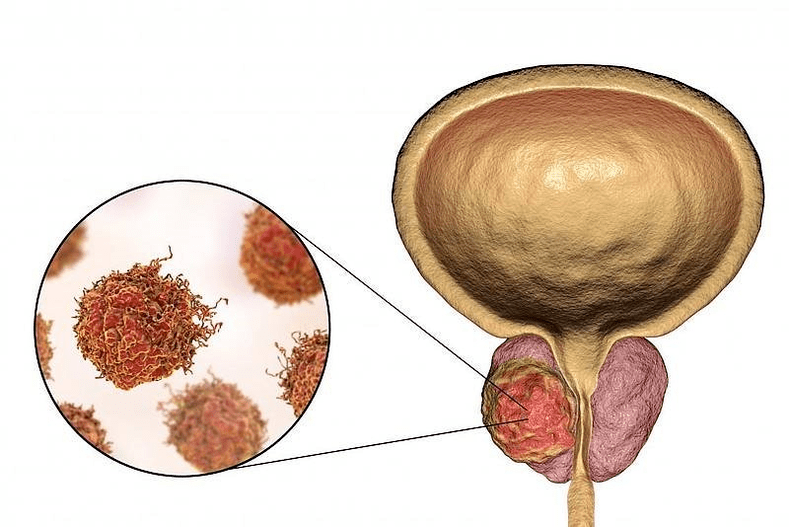 ako vyzerá poškodenie prostaty
