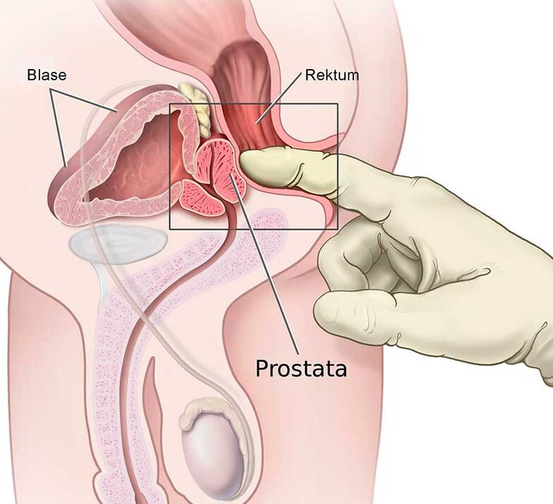 masáž prostaty pri prostatitíde
