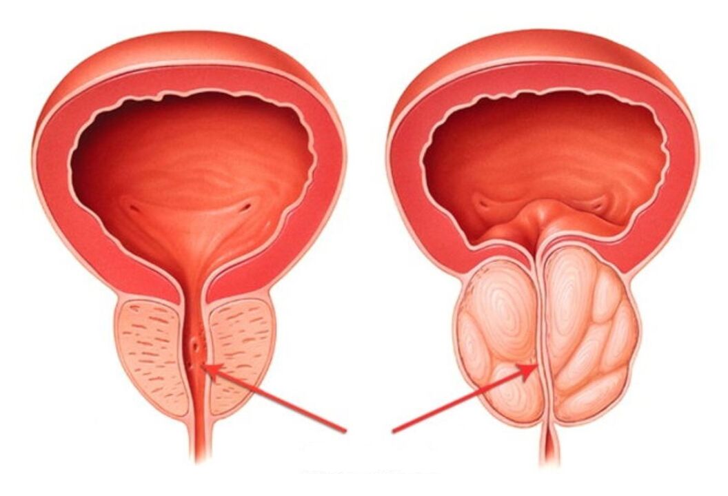 zdravá a zapálená prostata s prostatitídou
